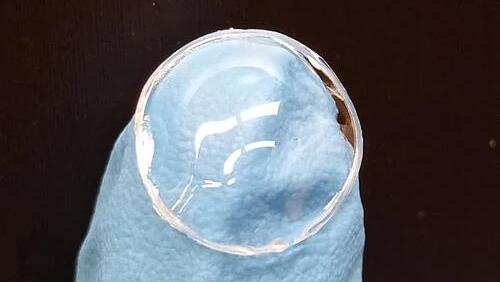 An example of a contact lens with the Waterloo research team's hydrogel "stitched" on it. The hydrogel is 3D-printed throughout the periphery of the lens. (University of Waterloo)